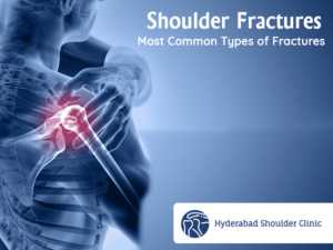 Read more about the article Shoulder Fractures: Most Common Types Of Fractures