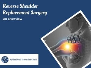 Read more about the article Reverse Shoulder Replacement Surgery: An Overview