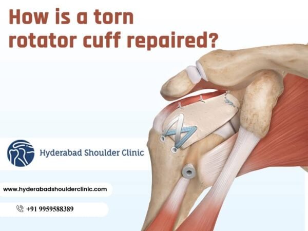 How Is A Torn Rotator Cuff Repaired? - shoulder clinic Hyderabad