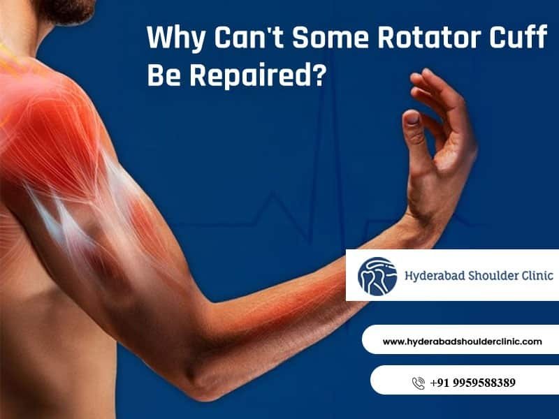 Read more about the article Why Can’t Some Rotator Cuff Be Repaired?