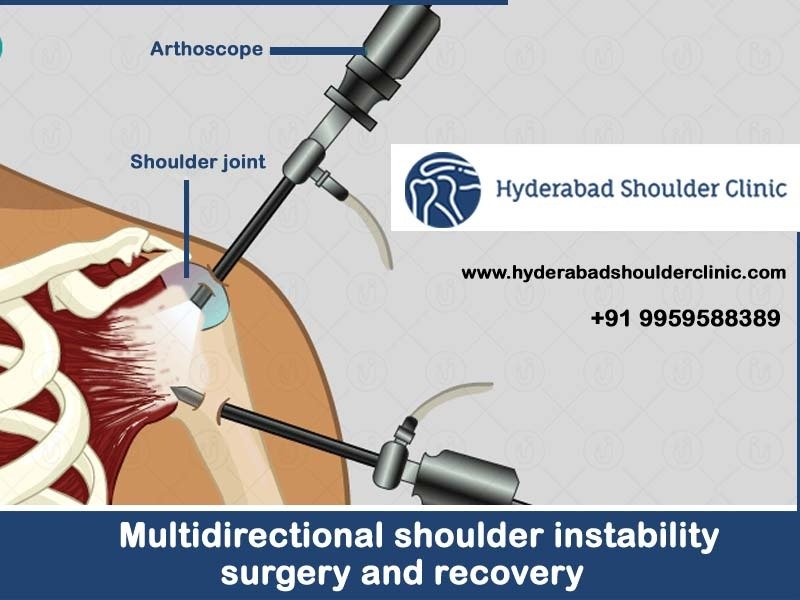 You are currently viewing Multidirectional Shoulder Instability Surgery And Recovery