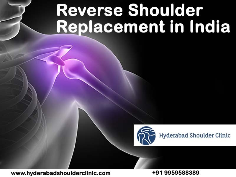 Read more about the article Reverse Shoulder Replacement In India