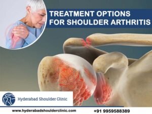 Read more about the article Treatment Options For Shoulder Arthritis