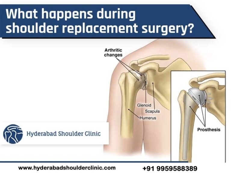 What Happens During Shoulder Replacement Surgery Shoulder Clinic Hyderabad