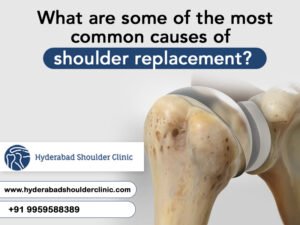 Read more about the article What Are Some Of The Most Common Causes Of Shoulder Replacement?