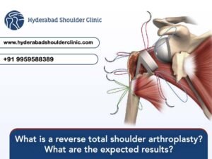 Read more about the article What is a reverse total shoulder arthroplasty? What are the expected results?