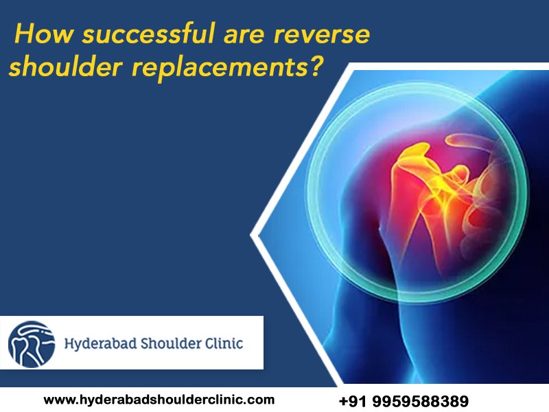 Read more about the article How successful are reverse shoulder replacements?