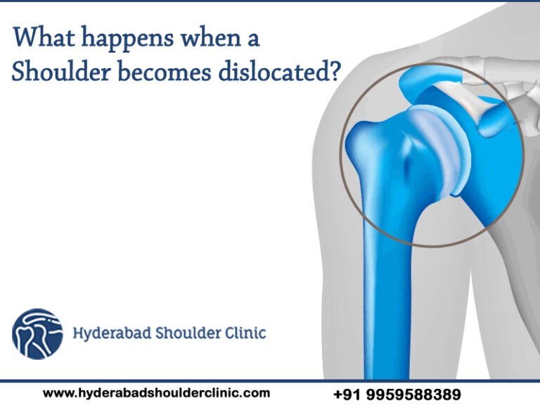 What happens when a shoulder becomes dislocated? - shoulder clinic ...