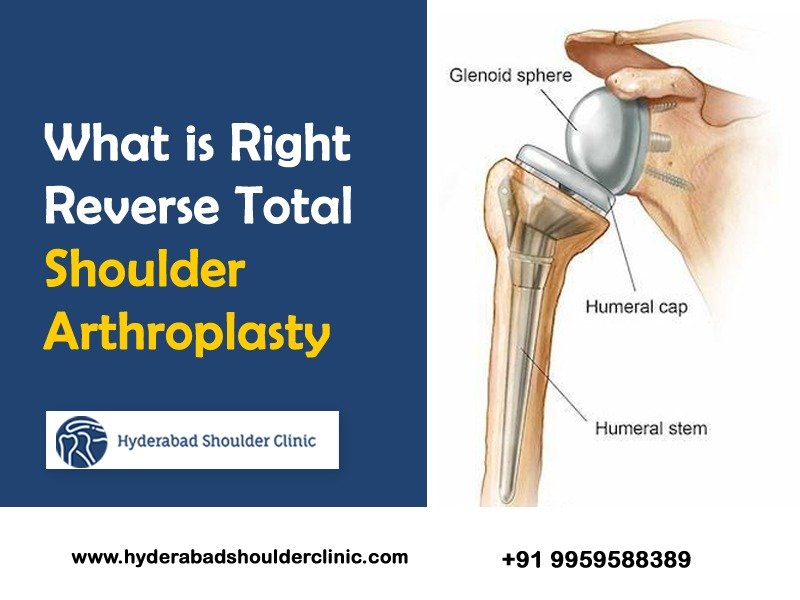 You are currently viewing What is Right Reverse Total Shoulder Arthroplasty