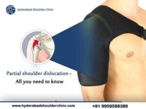 Read more about the article Partial shoulder dislocation – All you need to know