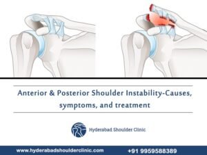 Read more about the article Anterior & Posterior Shoulder Instability – Causes, symptoms, and treatment