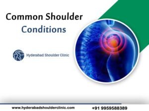 Read more about the article Common Shoulder Conditions