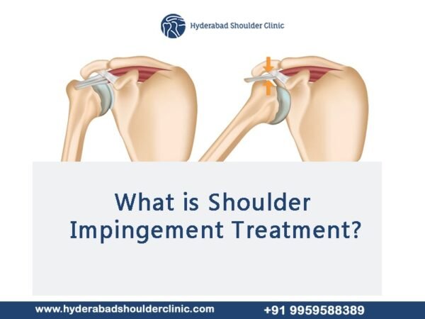 What Is Shoulder Impingement Treatment Shoulder Clinic Hyderabad 8704