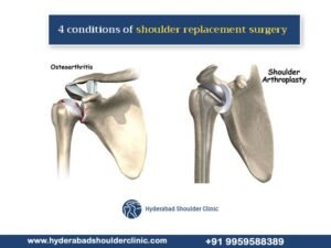 Read more about the article Four conditions of shoulder replacement surgery