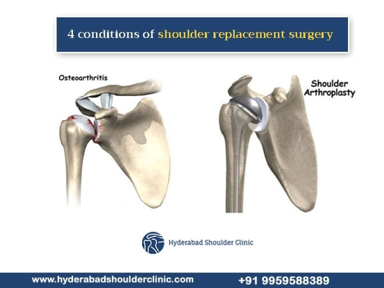 Four Conditions Of Shoulder Replacement Surgery Shoulder Clinic Hyderabad