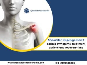 Read more about the article Shoulder impingement causes symptoms, treatment options and recovery time.