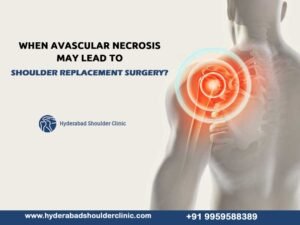 Read more about the article When avascular necrosis may lead to shoulder replacement surgery?