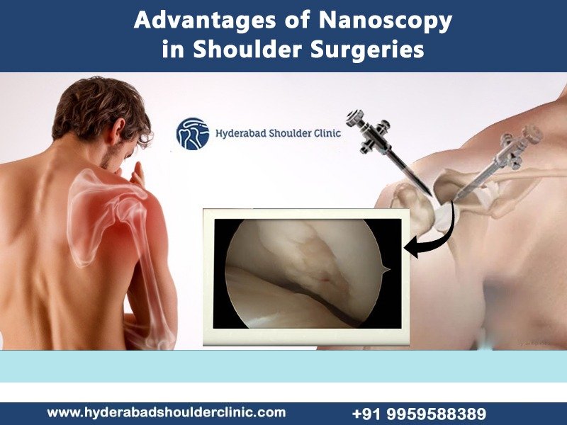 Read more about the article Advantages of Nanoscopy in Shoulder Surgeries