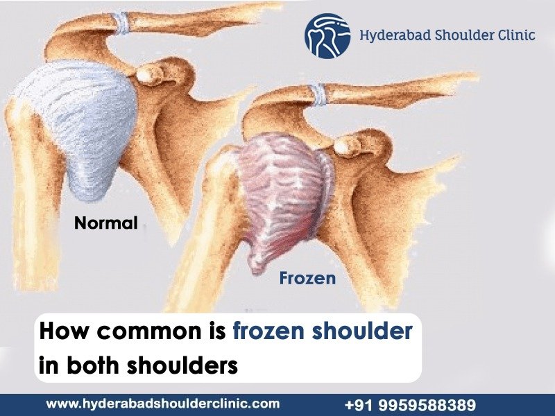 Read more about the article How common is frozen shoulder in both shoulders?