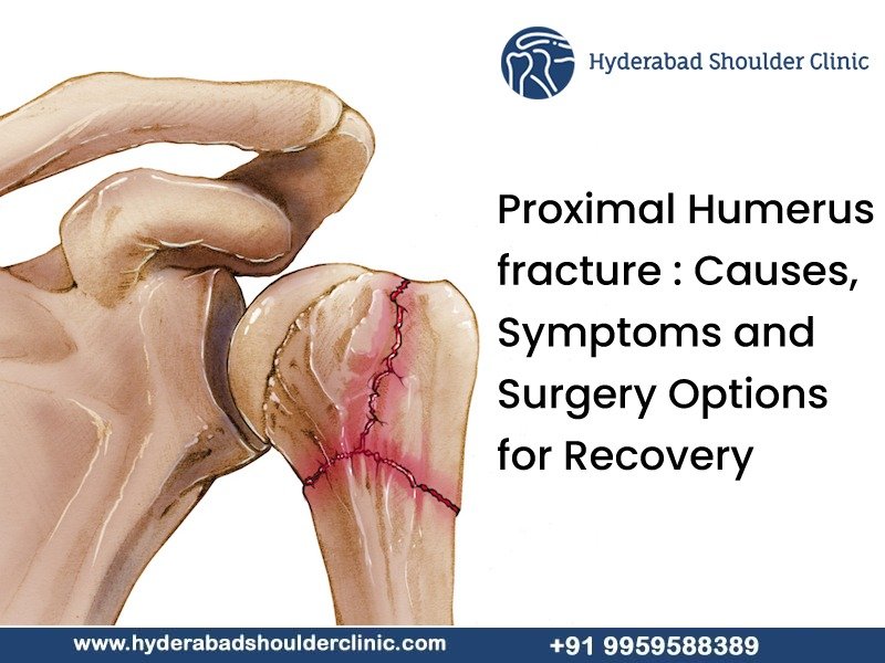 You are currently viewing Proximal Humerus Fracture: Causes, Symptoms and Surgery Options for Recovery