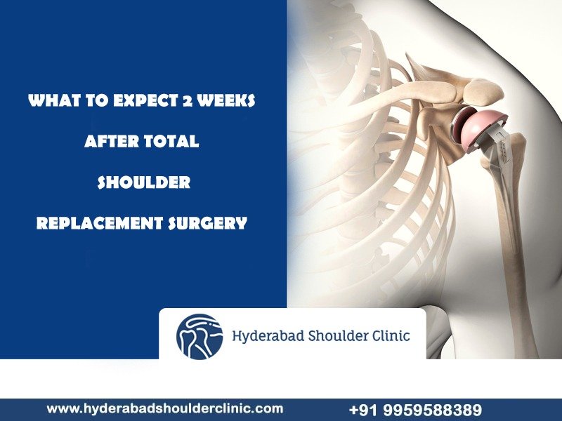 You are currently viewing What can you expect two weeks after total shoulder replacement surgery?