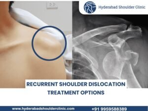 Read more about the article Recurrent shoulder dislocation treatment options  in Hyderabad