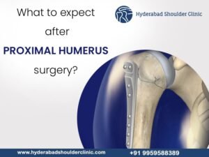 Read more about the article What to expect after proximal humerus surgery?