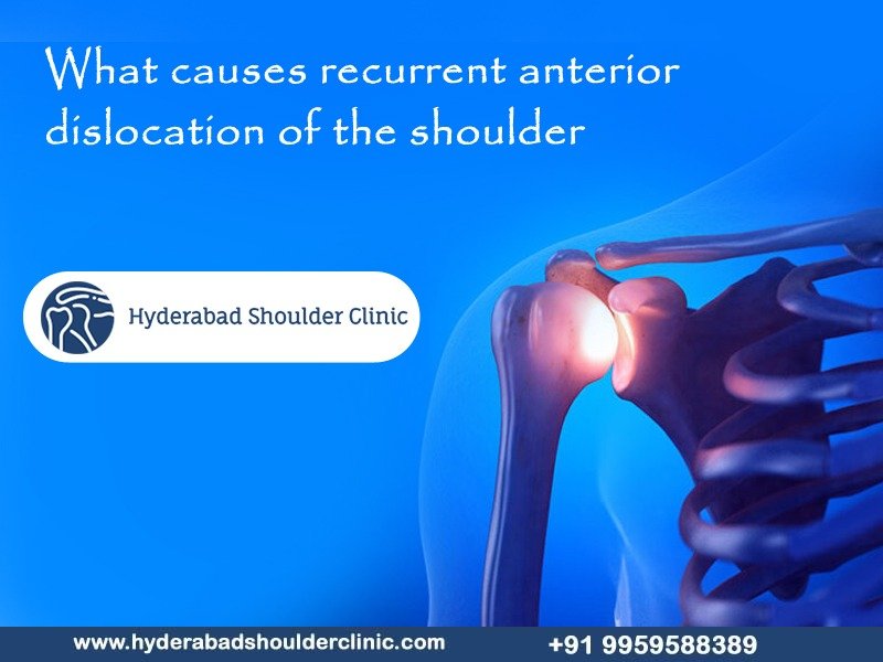 You are currently viewing What causes recurrent anterior dislocation of the shoulder?