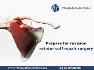 Read more about the article Prepare for revision rotator cuff repair surgery