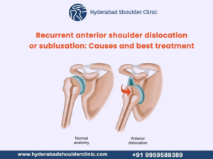 Read more about the article Recurrent anterior shoulder dislocation or subluxation: Causes and best treatment